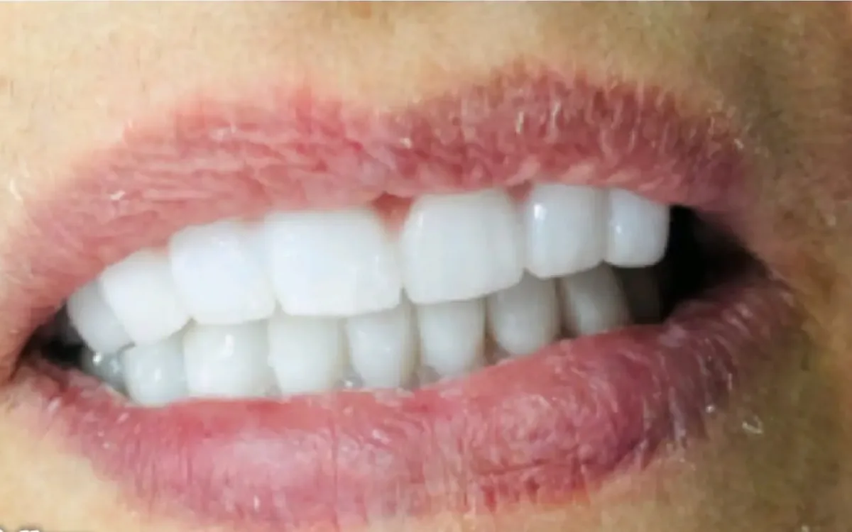 After: Full-mouth rehabilitation — crowns & bridges